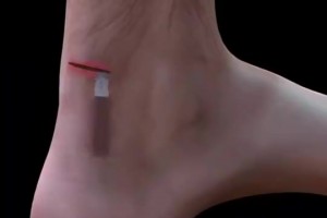 看着都疼！科普视频：球员脚跟腱断裂是如何进行修复的？